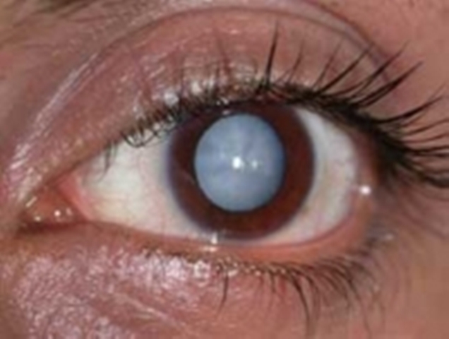 विराटनगर महानगरपालिकामा मोतियाबिन्दुरहित अभियान 