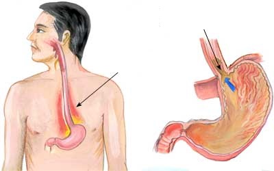 मुखमा अमिलो पानी आउने, छाती तथा घाँटी पोल्ने समस्या ‘हार्ट बर्न’ के हो ?