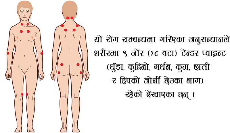 घुँडा, कुहिनो, गर्धन, कुम, छाती र हिपको जोर्नीमा दुख्ने रोग के हो ?