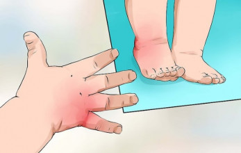 नवलपरासीमा सिकलसेलका ३ बिरामी