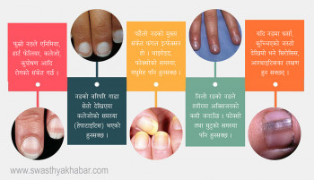 नङमा परिवर्तन आउँदैछ? याद राख्नुस्, गम्भीर रोगको संकेत हुनसक्छ