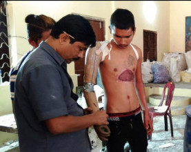 कृत्रिम हातखुट्टा पाउँदा : करेन्ट लागेर हात  र दुर्घटनामा खुट्टा गुमाउने सबै दंग