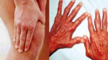 नेपालमा पहिलो पटक बाथरोग चिकित्सकको सम्मेलन हुने