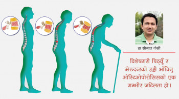 ओस्टिओपोरोसिस : कारण र निवारण