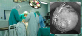 ६२ वर्षीया काशी देवीको पाठेघरबाट ५ किलोको ट्युमर निकालियाे