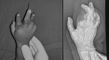 २२ महिने बालकको बाइकले चुँडाएको २ वटा औँला शल्यक्रियापछि जोडिए