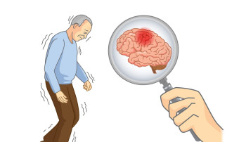 एन्ड्र्यूको कथा: जब पार्किन्सनको औषधिले परिवारलाई नै ध्वस्त बनायो