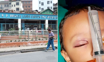 ३ वर्षीय बालकको आँखाबाट मस्तिष्कसम्म पुगेको काँटीको बीपी नेत्र अध्ययन केन्द्रमा दुर्लभ शल्यक्रिया