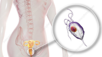 महिला योनी र पुरुषको मूत्रनलीमा हुने संक्रमण 'ट्राइकोमोनास'